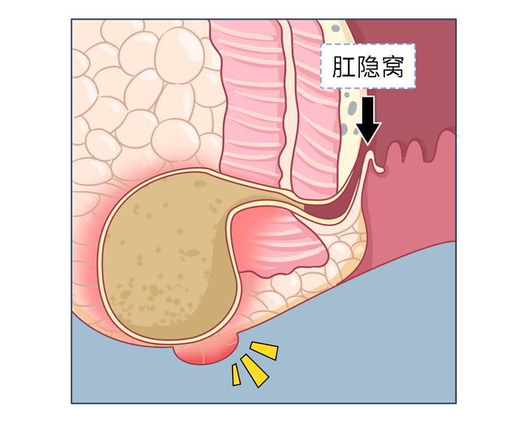 低位肛瘘手术后图片图片