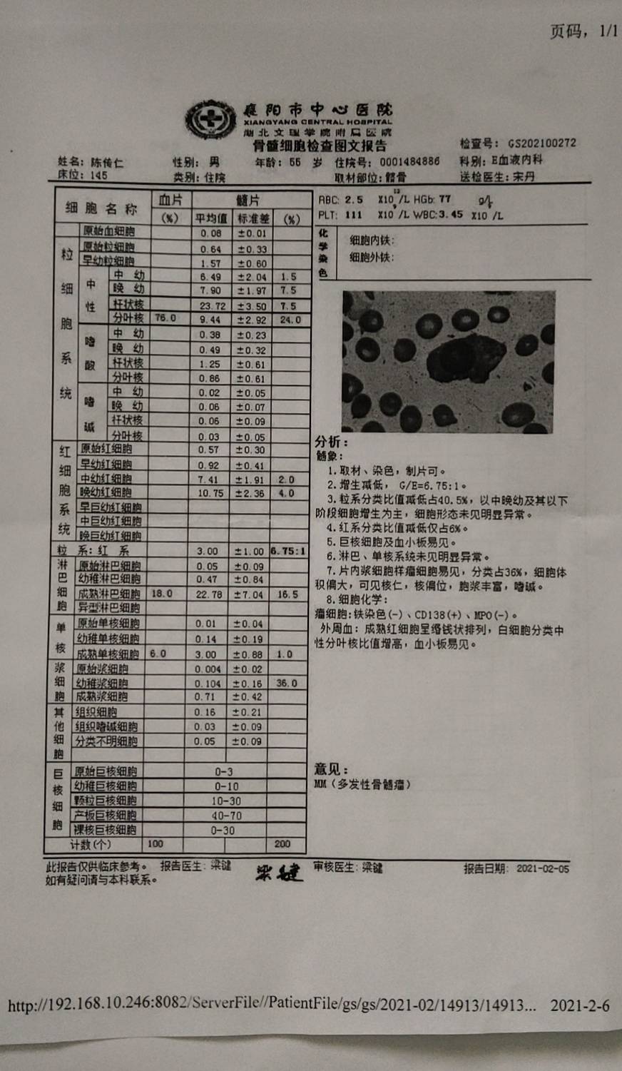 多发性骨髓瘤病理报告图片