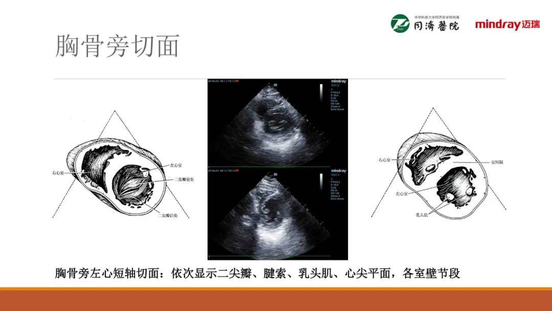围术期经胸超声心动图tte