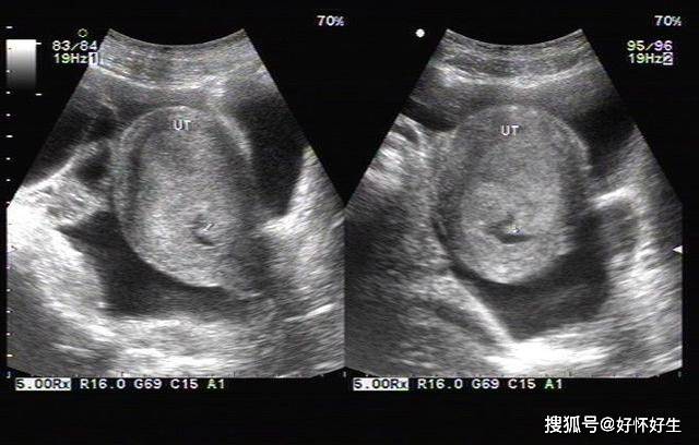 试管婴儿取卵后腹胀怎么办