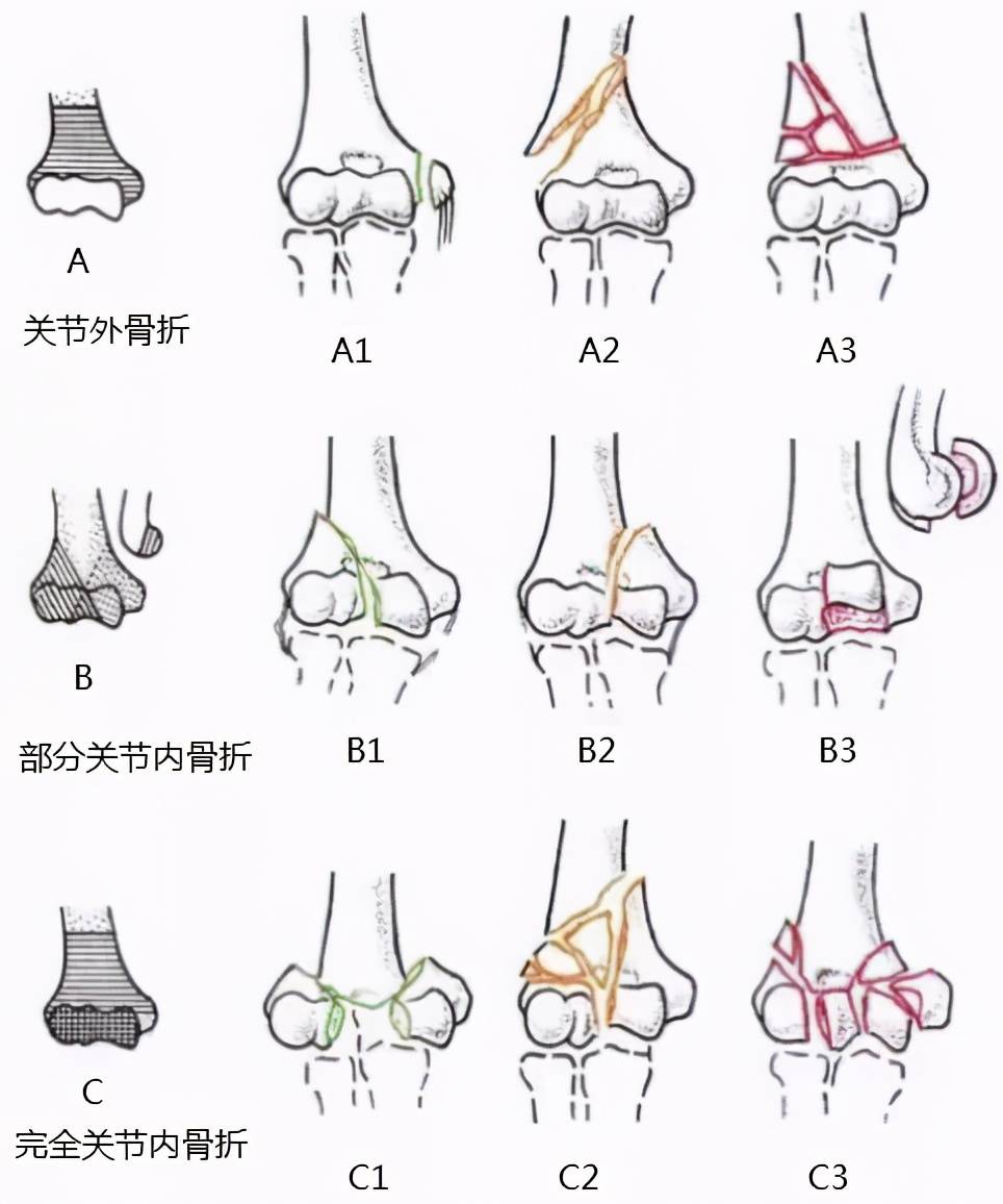 肱骨远端粉碎性骨折怎么办