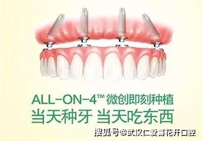 全口缺失牙 全口即刻修复种植牙技术 患者