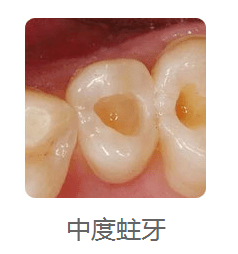 中龋