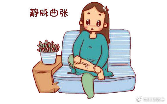为什么静脉曲张缠上女性朋友女人静脉曲张有哪些症状