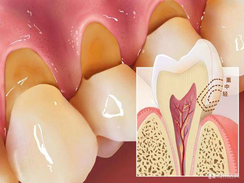 牙齿敏感酸痛可能是被刷出楔状缺损