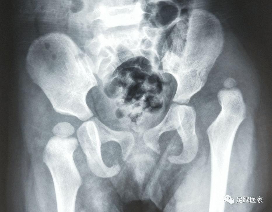 門診見聞錄1臀紋不對稱就一定代表髖關節發育不良嗎