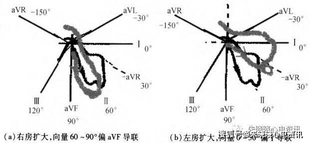 15 mv;v1导联上p波负向部分 0.