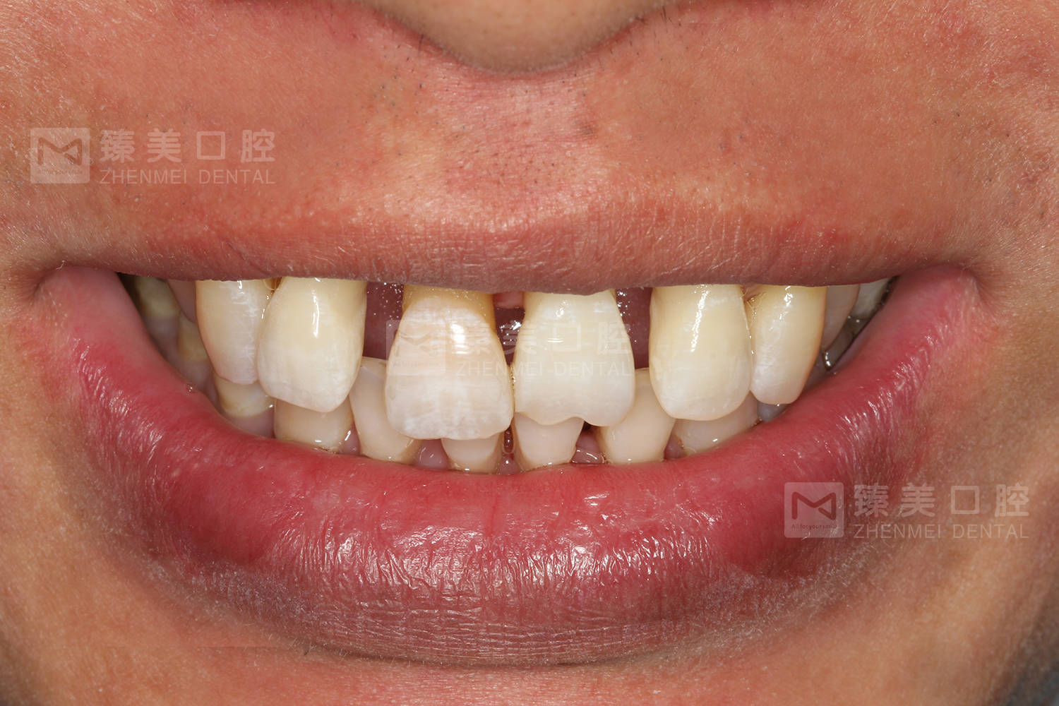 新疆臻美口腔牙缝过大是否可以用贴面来修饰