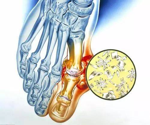 難道痛風石除了手術,就沒有其他治療方法嗎?_尿酸