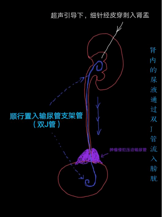 肾积水插管手术图解图片