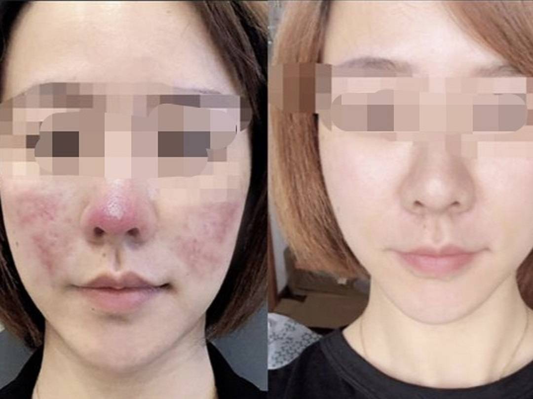 56年的酒糟鼻太糟心了过来人的总结28天草莓鼻说拜拜