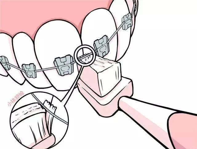 如何解决牙齿矫正背后的隐患