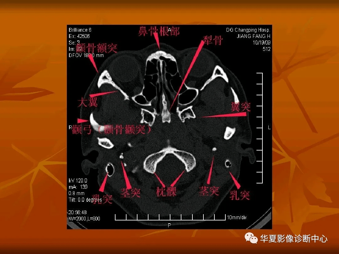 顱底ct高清圖解 常見骨折部位圖示