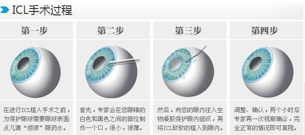 烟台康爱眼科科普 Icl晶体手术和全飞秒近视手术的区别 激光