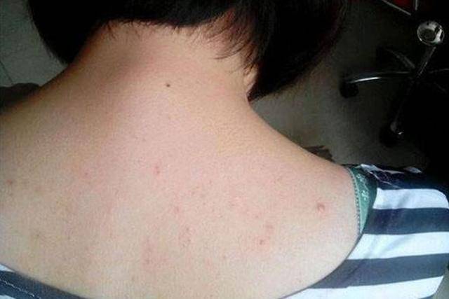 原创后背经常长痘,或许是螨虫在作怪,学会3招,杀菌除螨,减少痘痘