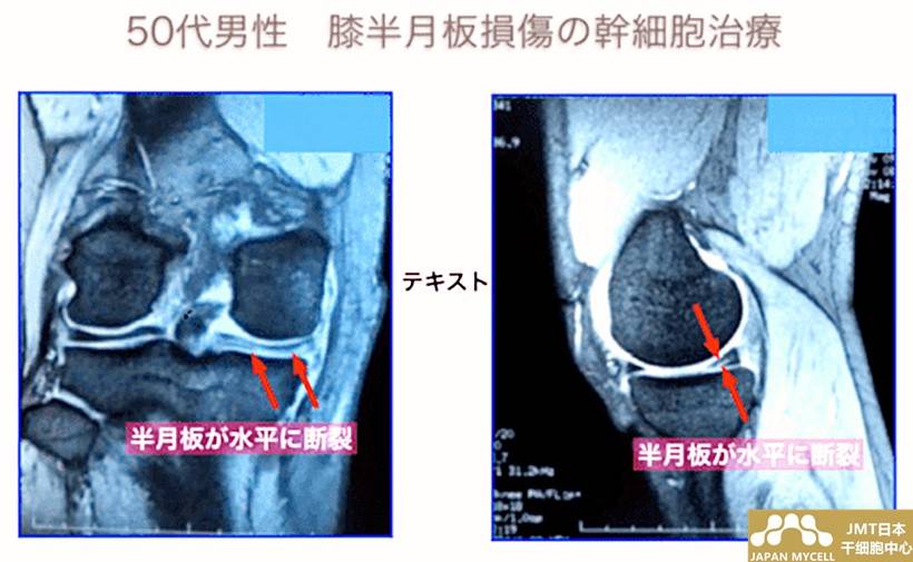 Jmt日本干细胞案例 50岁日本男性半月板损伤的干细胞治疗 进行