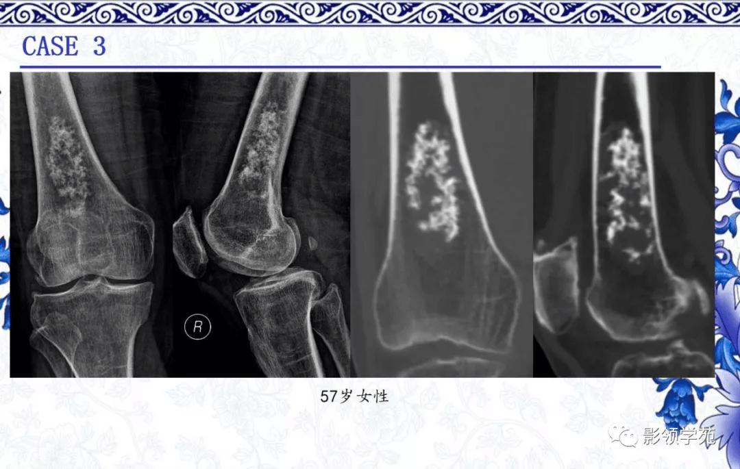 7种常见的软骨源性肿瘤的影像表现_骨瘤