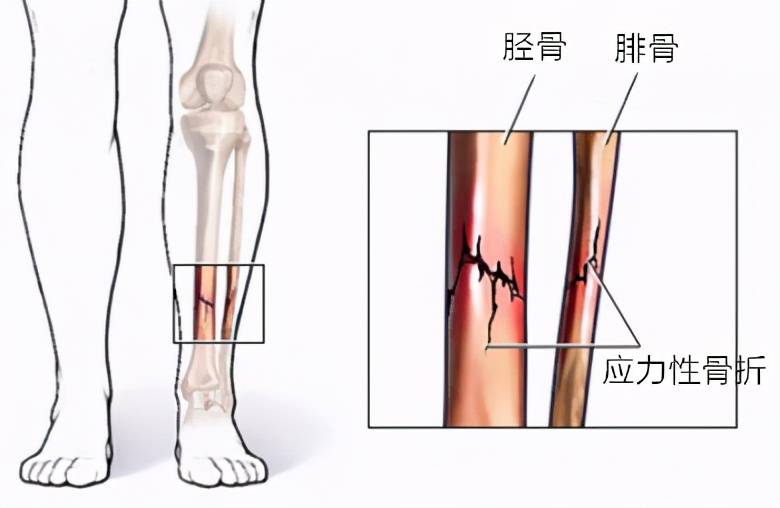 的2～3天,從骨內膜及骨外膜增生的纖維母細胞及新生毛細血管侵入血腫