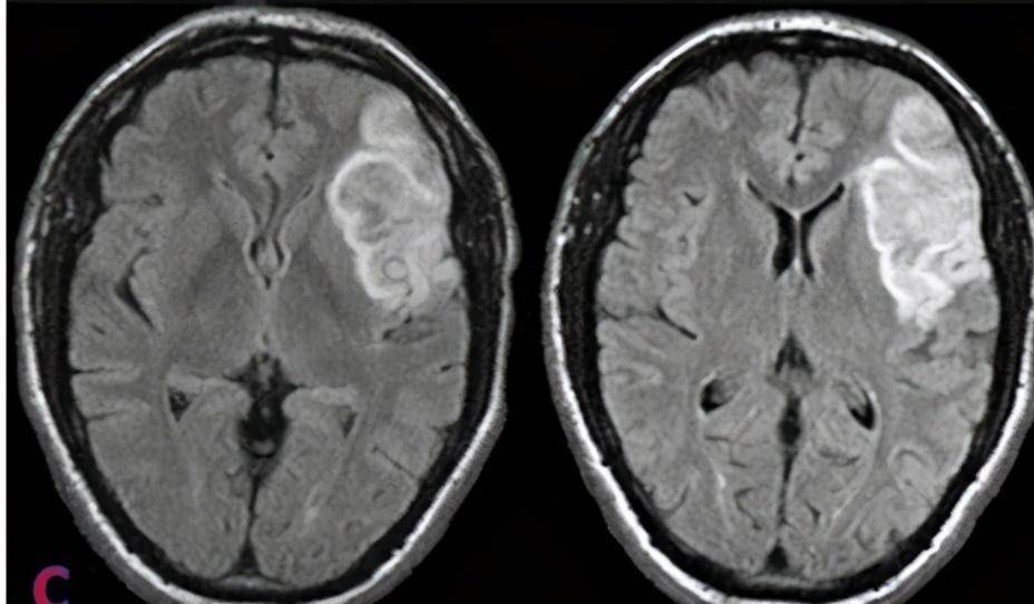 什么是动脉斑块和血栓 0375ea192075412992df2c1012036806.jpeg