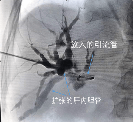 多切面探查,尋找最佳路徑,引導穿刺針一針穿入目標膽管,置入引流管