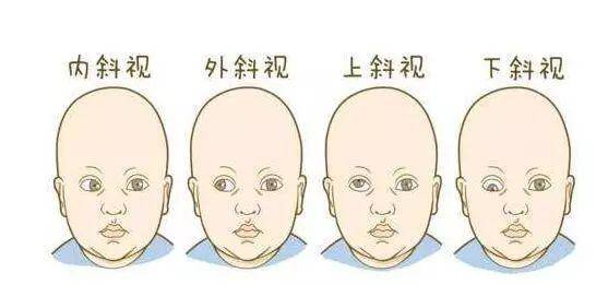 什么是双眼融合功能 8bad64342e0e48d7b2bd8dd17209cbe8.jpeg