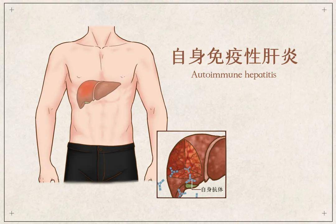 肝功能反复异常要警惕这个病可快速进展至肝硬化