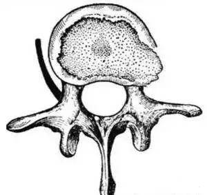 纤维环部分破裂,髓核从裂口处流出.