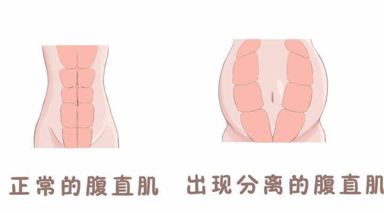 原创腰痛是产后妈妈难逃的劫与麻药无关也非月子病怀孕时就已注定