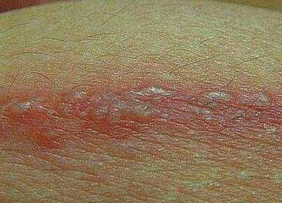 它不光有这一个名字,还有人管这种现象称之为"腰缠火丹" ,"蛇串疮"等