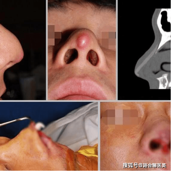 硅胶和膨体隆鼻哪种效果好答案来啦