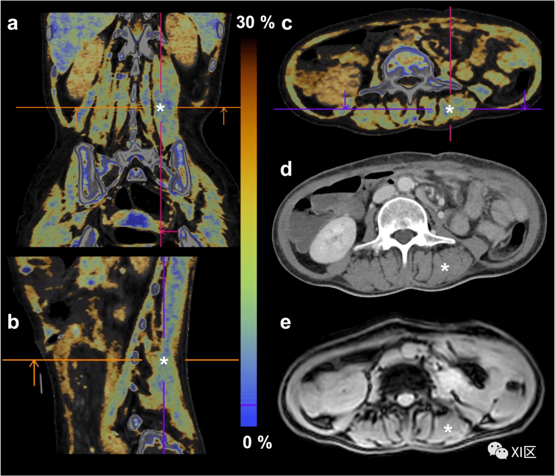双能ct骨骼肌脂肪定量