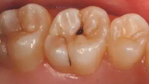 我牙挺好的只有一个小黑点