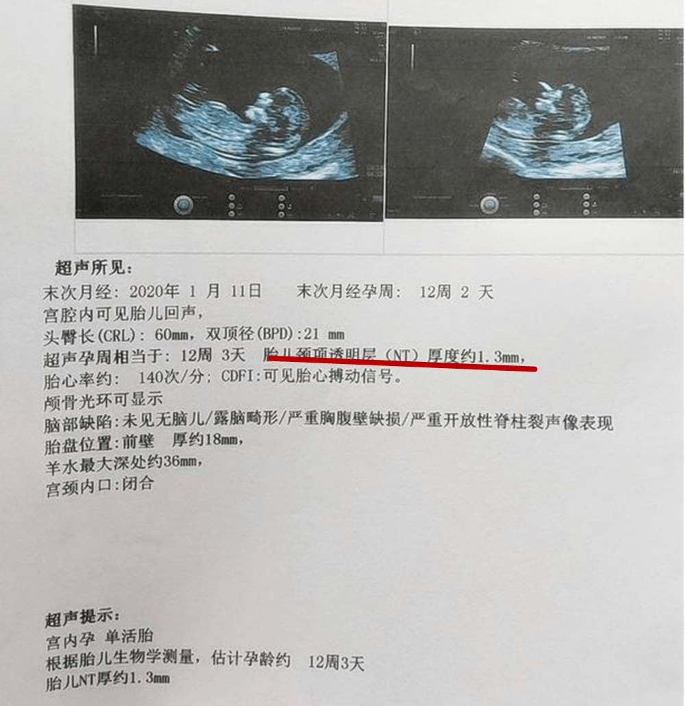 如果孩子的組織液堆積較多,那麼孩子存在智力發育異常的問題幾率就