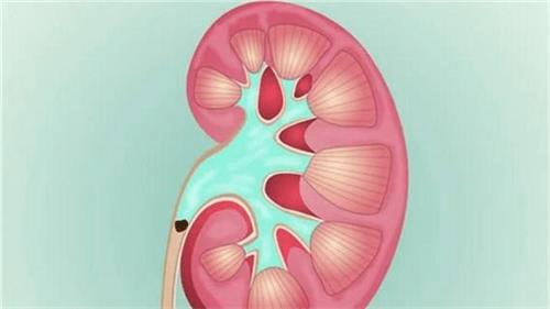 男子碎石4年後,結石再長堵住輸尿管