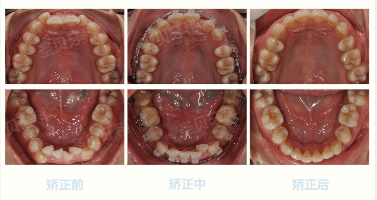 血牙套和夜幕套怎么搭_隐形牙套