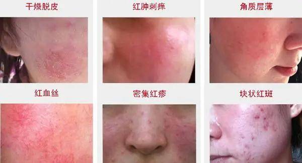 激素性皮炎怎么形成的？激素性皮炎的症状表现?