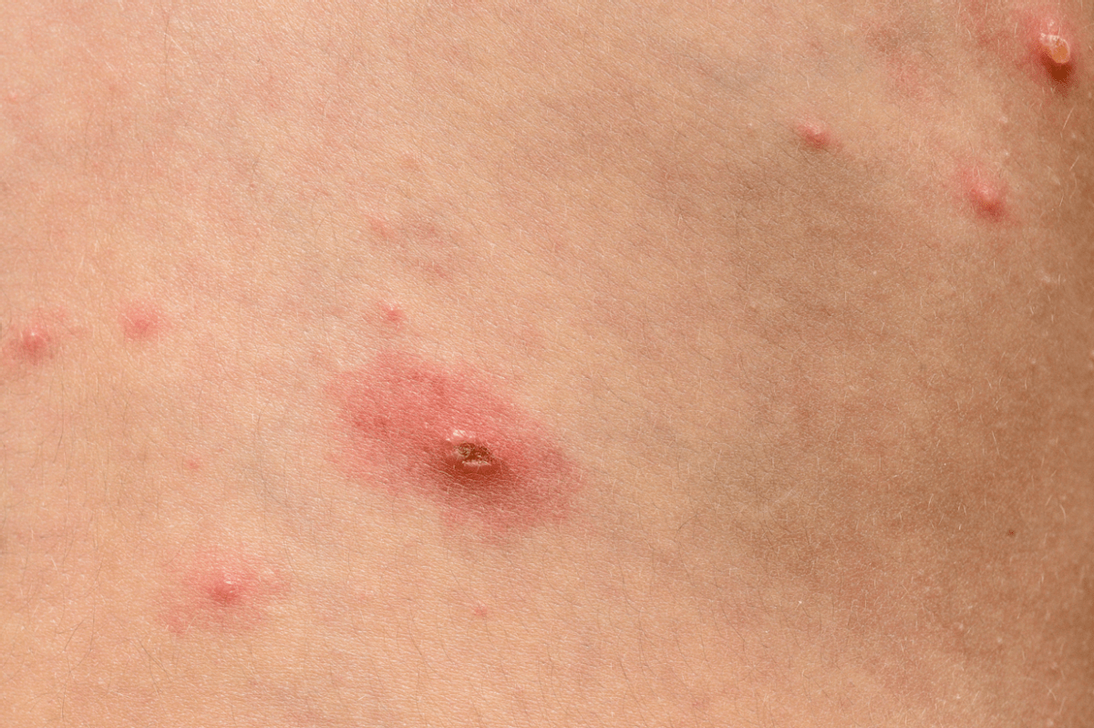 但是过了段时间,安安发现这个小红点越长越大,形成了"菜花状"的疙瘩