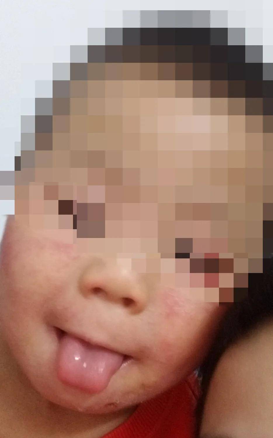 李金洁医师抓抓抓痒痒痒干性湿疹困扰小宝宝