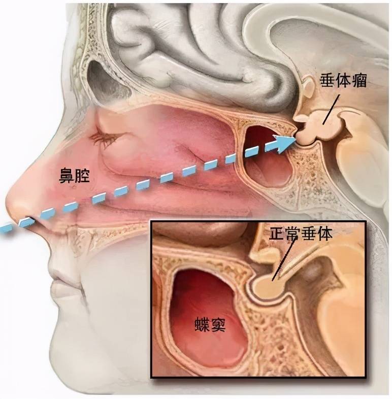 垂体位于大脑底部的中央位置,虽然只有豌豆一般大小,但其拥有强大的内