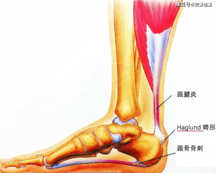 泡脚,水温40摄氏度左右,每次30分钟,可加快足底血液循环,促进炎症吸收