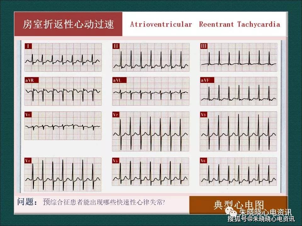 预激综合征（ppt）