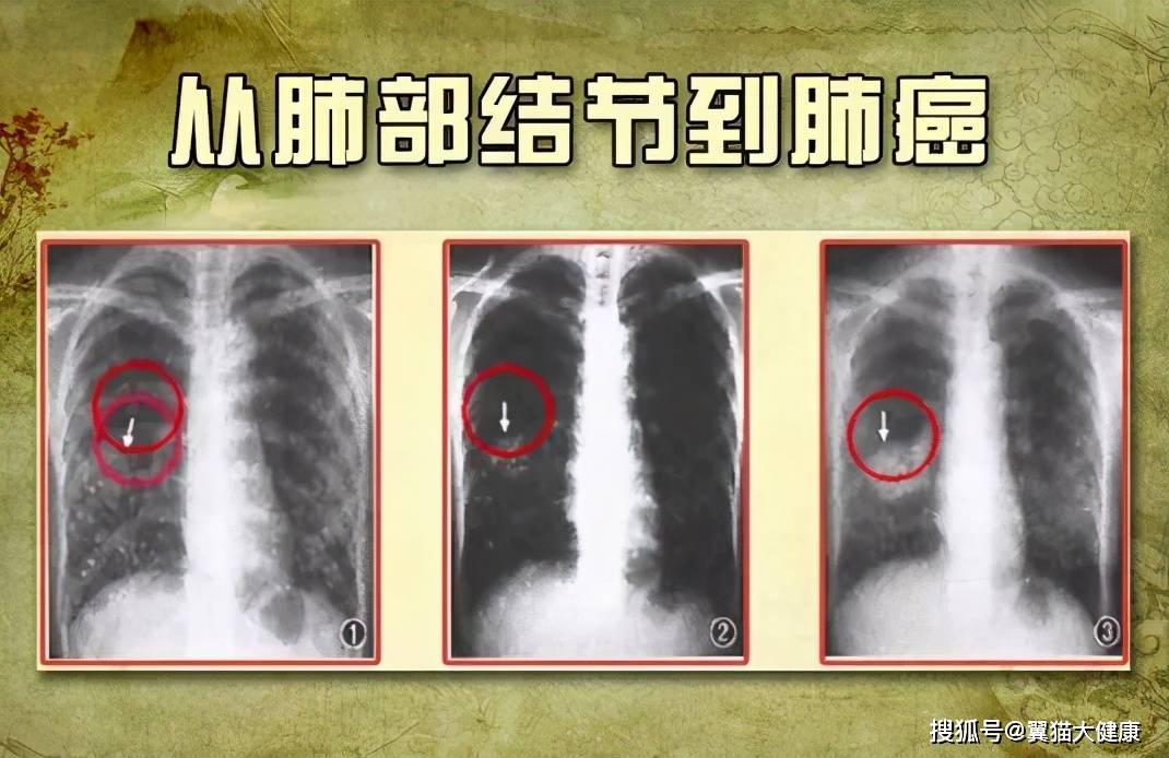 橘红痰咳颗粒能去痰吗_支气管炎咳黄痰和白痰_痰咳净散