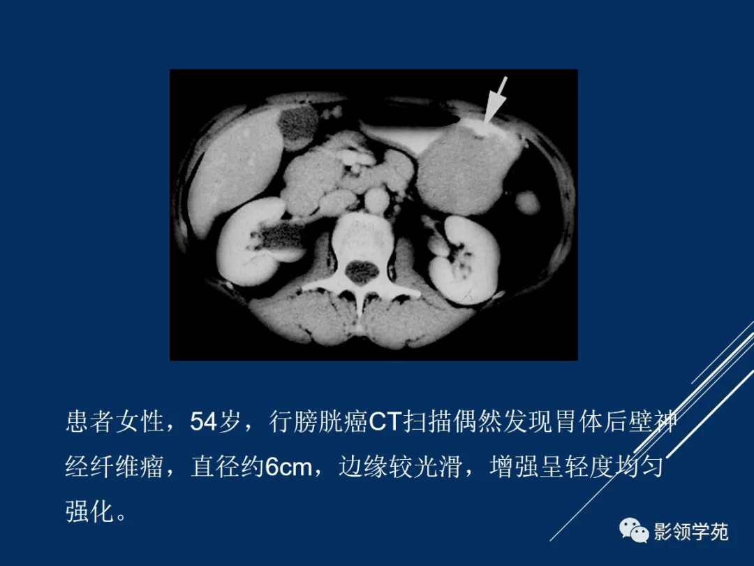 15個病例熟悉胃腸道間質瘤影像表現