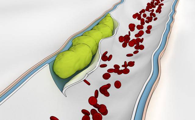 高密度脂蛋白是什么病 4ea7ebe448514c1e8116b863985c3f33.jpeg