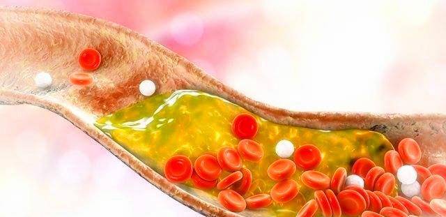 怎样快速降甘油三脂 3df4ed41f7e9442f9af3c109b2bd09ce.jpeg