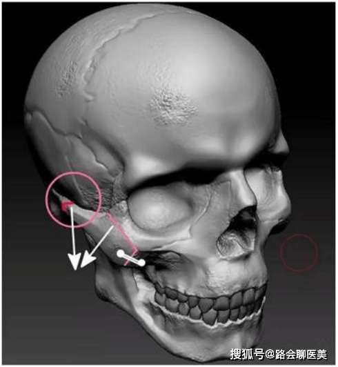 如果颧骨内推范围超过颧弓根截面,推多后端骨头连不上,只能靠钛板固定