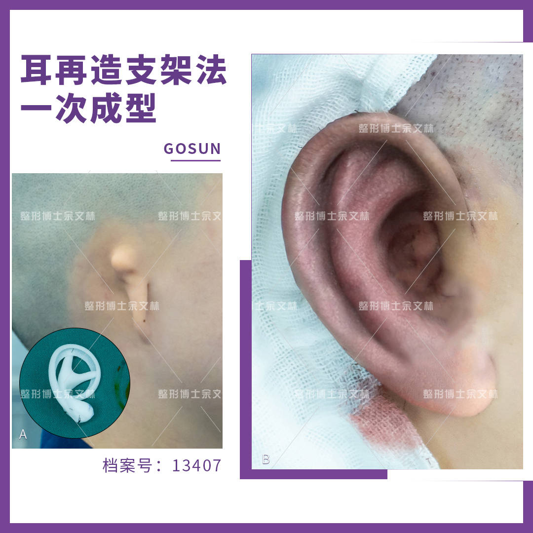 贯通的孔隙,历经12年的临床试验,被广泛应用于植入人体的生物医学材料