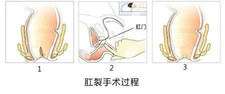 扛裂怎么办