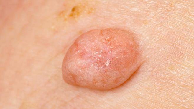 皮肤上长多余的 小肉球 是什么 会癌变吗 为健康了解下 生物