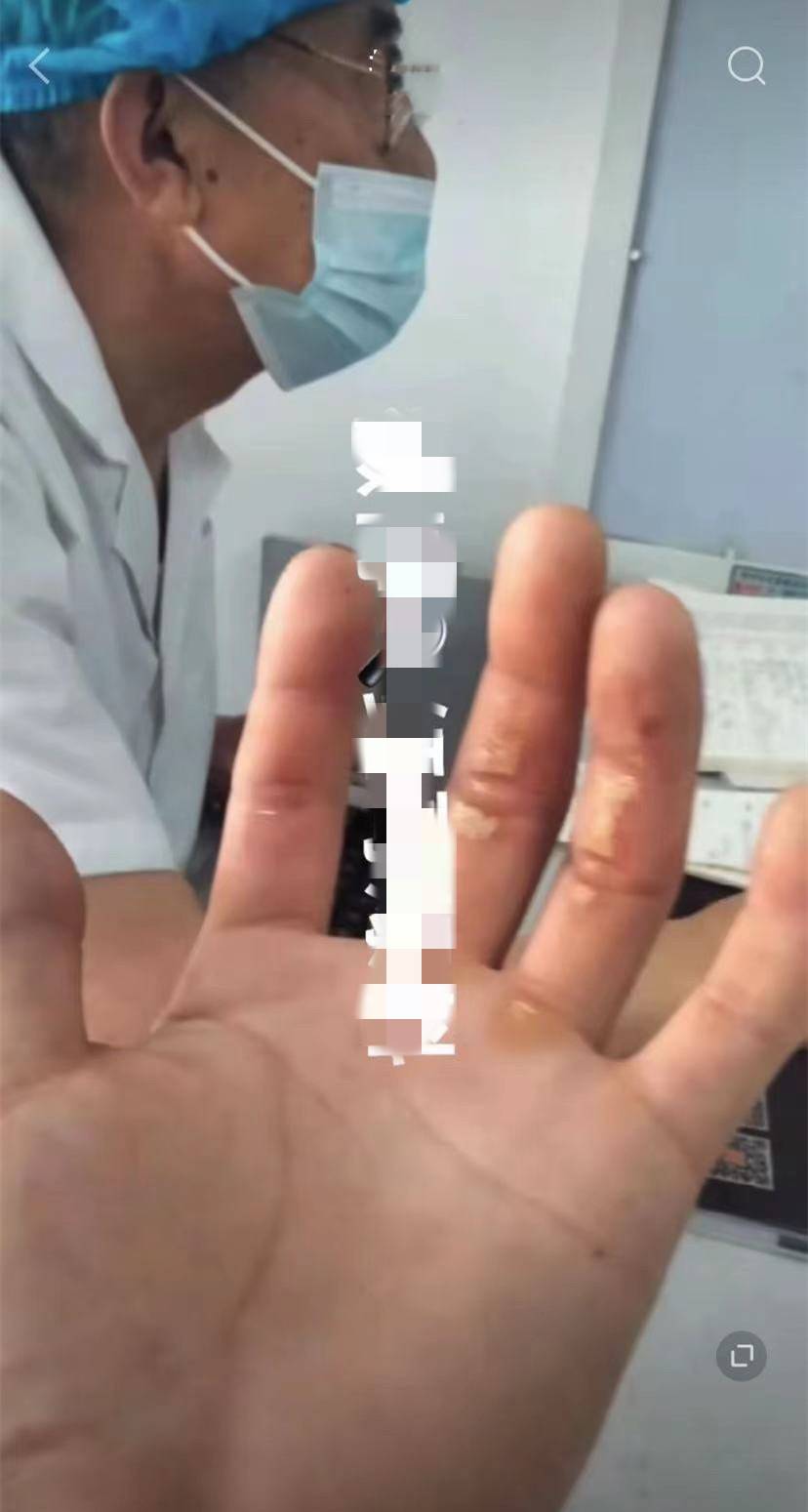 网红二驴直播间售卖手机爆炸 粉丝被炸伤手指缠满绷带(图2)